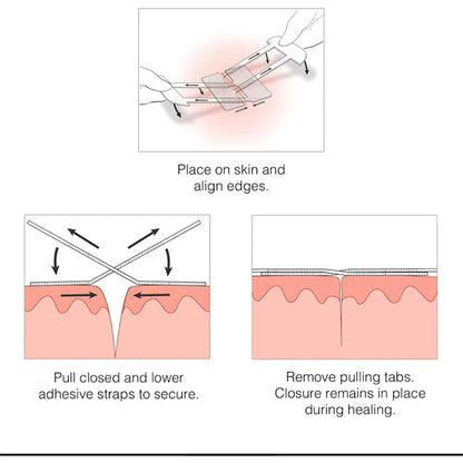 Clozex Emergency Laceration Kit - Complete Kit to Clean, Close, and Cover Wounds